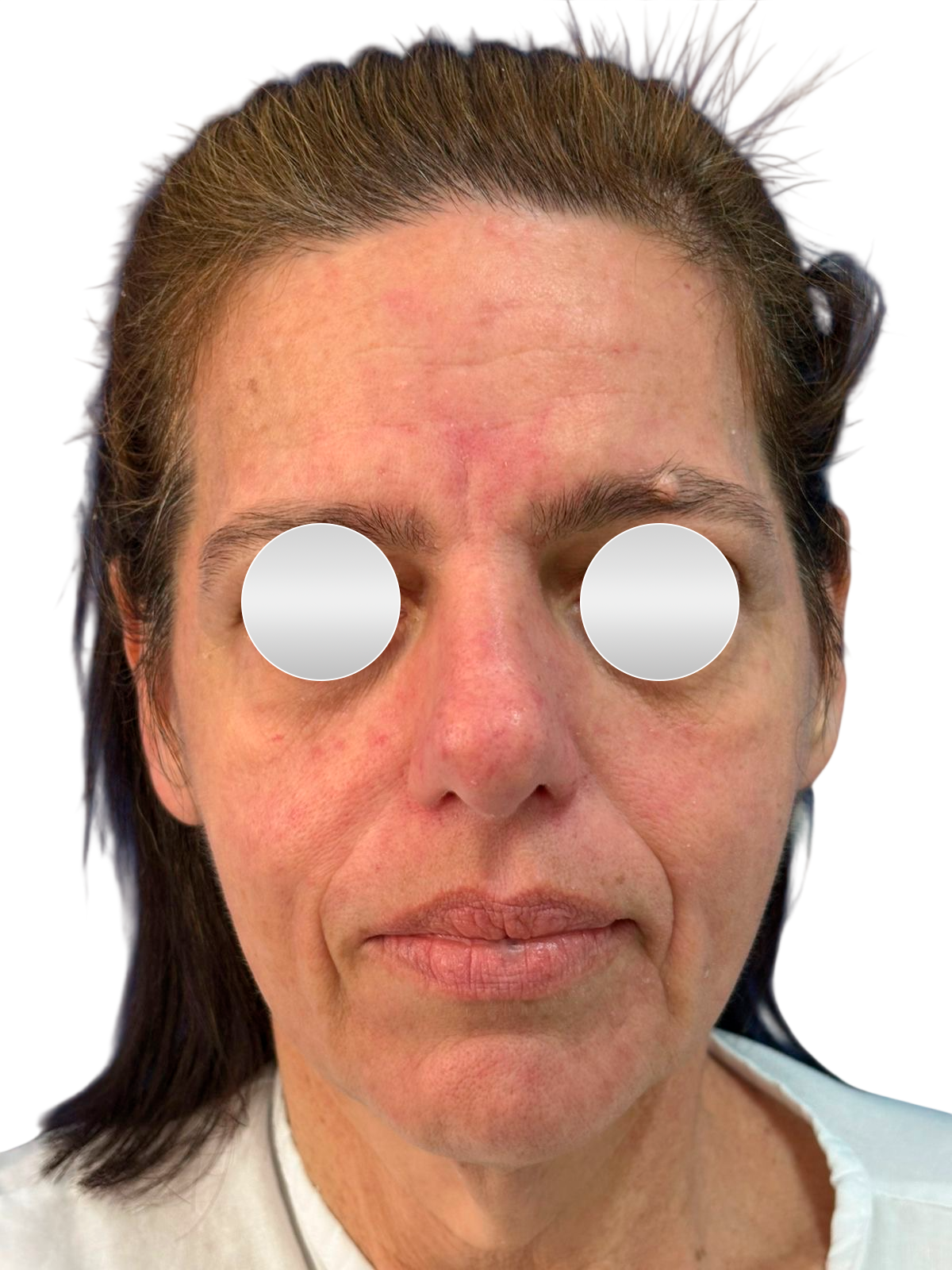 Antes do lifting facial — Frontal