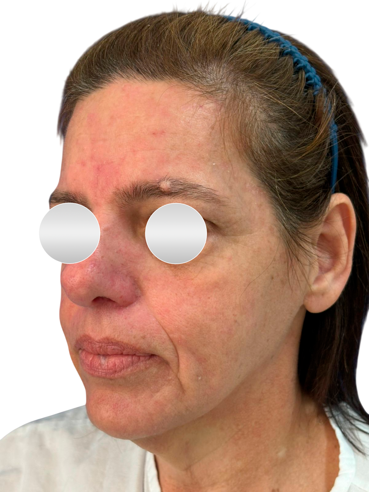 Antes do lifting facial — Perfil