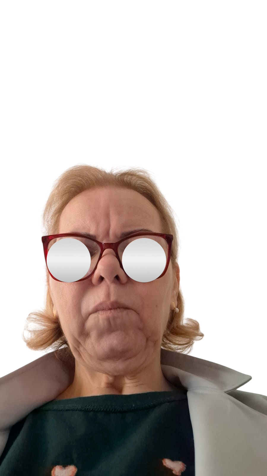 Antes do lifting facial — Perfil
