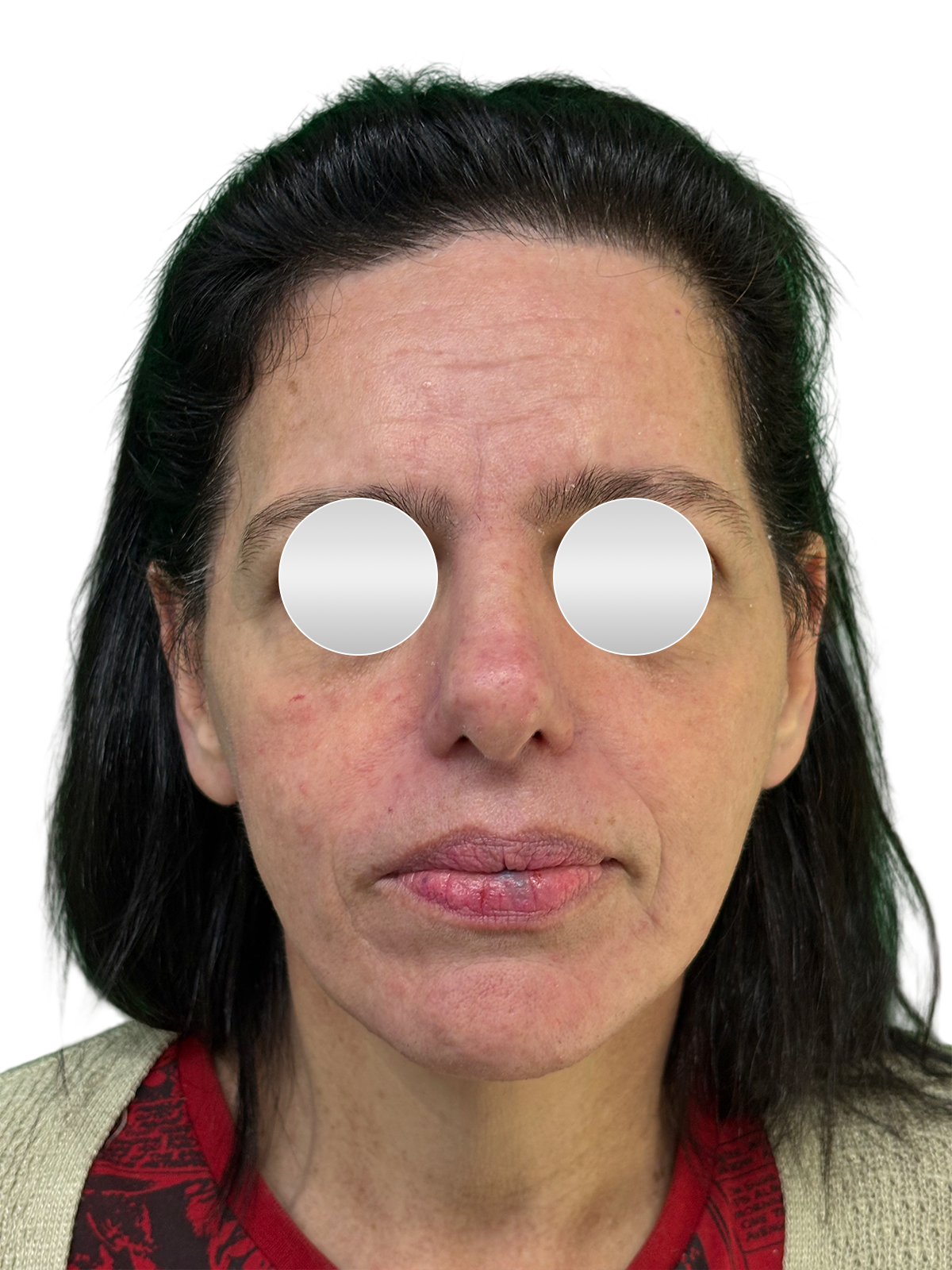 Depois do lifting facial — Frontal