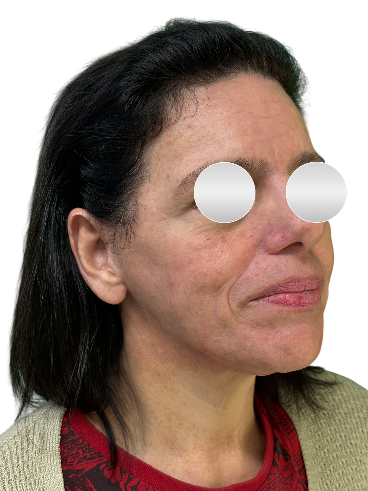 Depois do lifting facial — Perfil