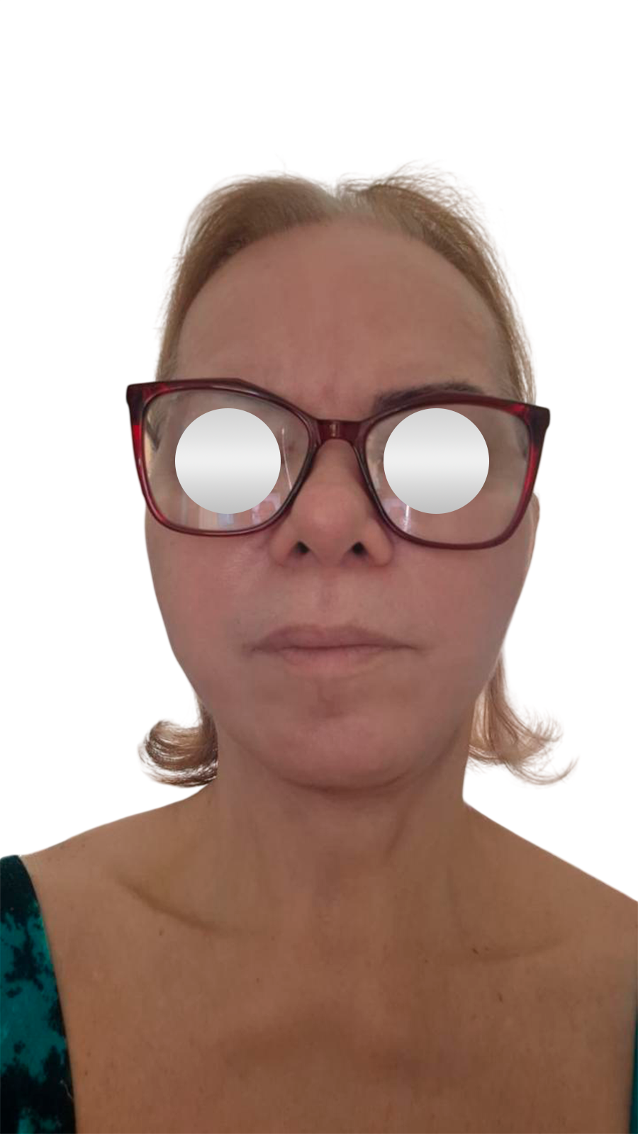 Depois do lifting facial — Perfil